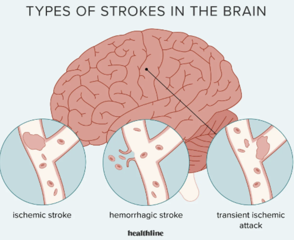 hemiplegia